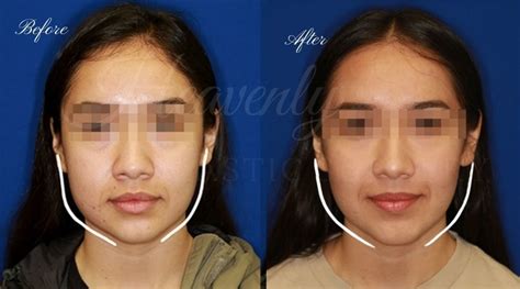 buccal fat removal 10 years later|10 Years Later Lasting Effects of Buccal Fat Removal